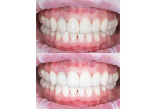 A before-and-after of a teeth whitening procedure is seen. A dentist checks for the correct shade to match a patient's teeth. Associates in Dentistry offers cosmetic dentistry in Washington IL.