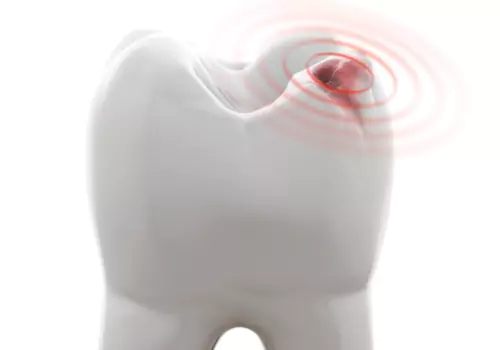 A model of an injured tooth is seen. Associates In Dentistry offers Emergency Dental Care.
