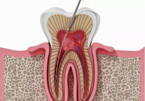 Root Canals Bartonville IL