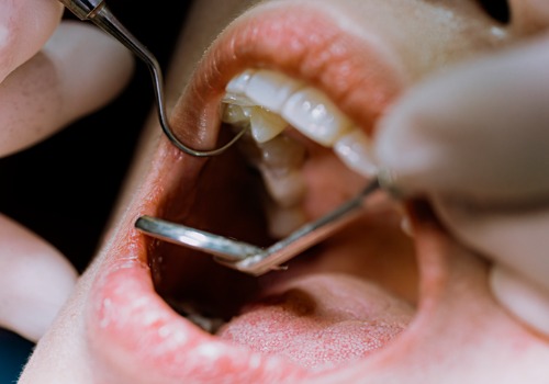 Close up of female patient getting her teeth examined for a root canal in Washington IL.