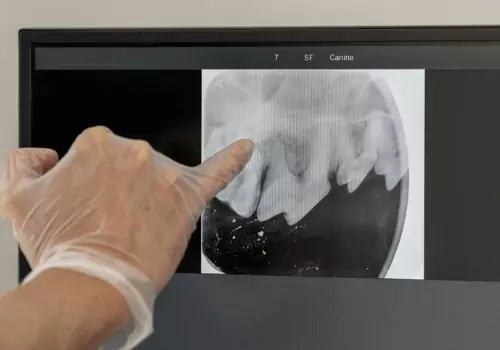 A dental X-ray is seen. Associates In Dentistry performs Root Canals in Peoria IL.