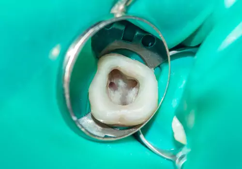 A close-up of a tooth is seen during a root canal procedure. Associates In Dentistry performs Root Canals in Canton IL.