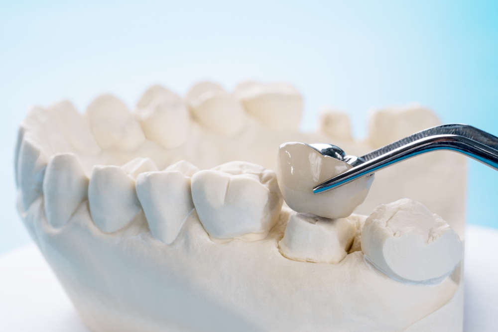 Image of dental crowns