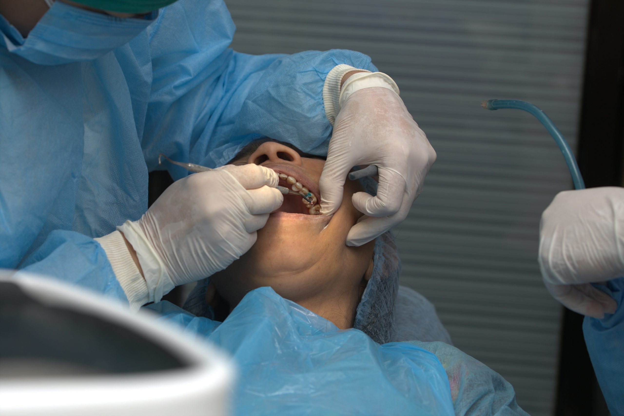 Image of tooth extraction process