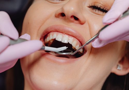 Image of Cavity Treatment