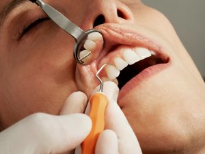 Image of Teeth Extraction