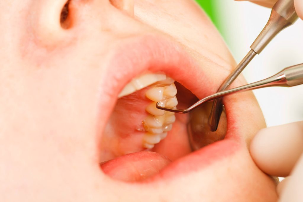 Image of Dental plaque removal