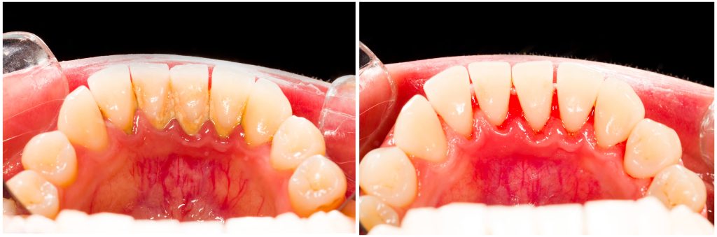 Image of Dental plaque removal