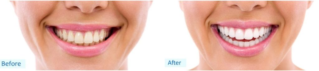 Image of Teeth bleaching