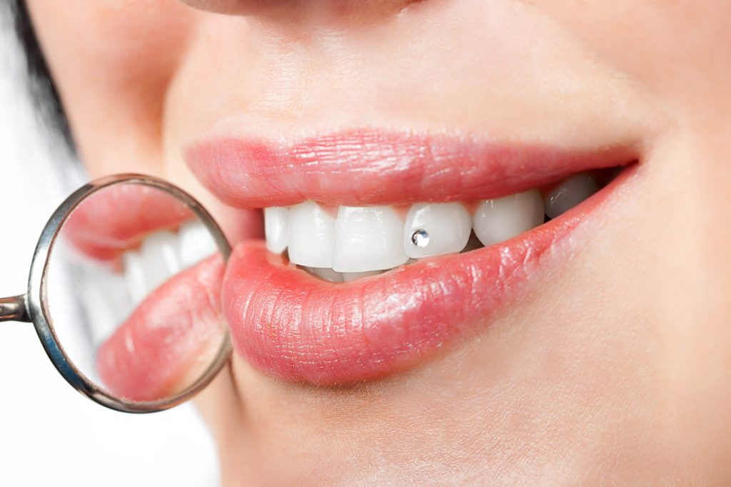Image of Whitening for Sensitive Teeth