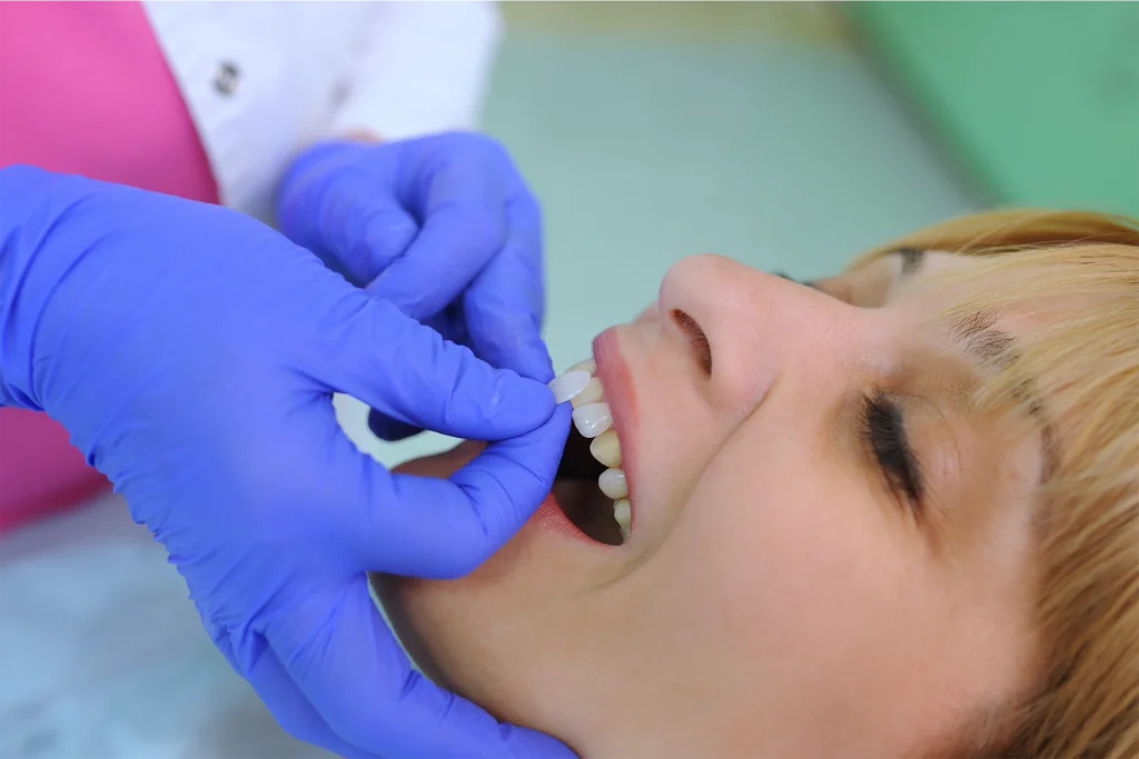 Image of Veneers being placed on a patient’s front teeth during a cosmetic dental procedure in Illinois