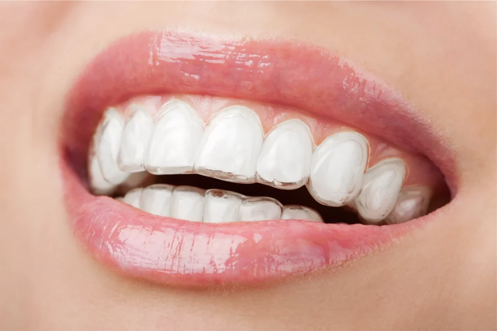 Image of teeth whitening kits worn on teeth during an at-home whitening treatment
